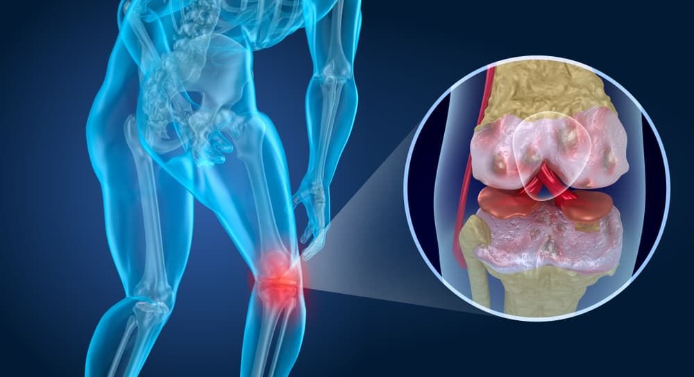Stem Cell Therapy for Knee Osteoarthritis: Clinical Trial Success